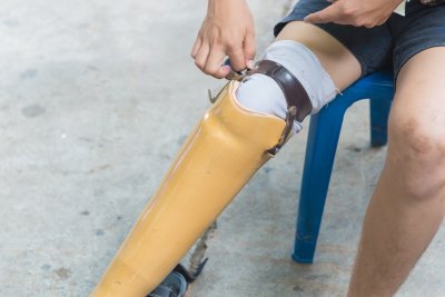 Kojos protezas