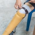 Modernūs protezai gali būti kompensuojami bet kokio amžiaus pacientams