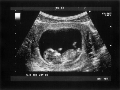 vaisius, gimda, nėštumas, ultragarsinis tyrimas, gimdymas