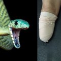 Po gyvatės įkandimo – nepagydomi sužalojimai ir galūnių amputacija: mokslininkai jau kuria naujos kartos priešnuodžius