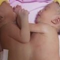 Kinijoje Siamo dvyniai laukia atskyrimo operacijos