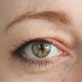 Gydytoja įspėja: net nesuprasite, kad jaučiamas skausmas kankina dėl užkritusių akių vokų