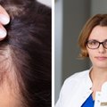Gydytoja atsakė į klausimus apie plaukų slinkimą: kada verta sunerimti ir kokios priemonės galėtų padėti