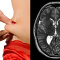 Žmogaus smegenis nuskenavę mokslininkai pamatė, kas joms nutinka numetus vos 1 proc. kūno svorio: rezultatą prilygino stebuklui