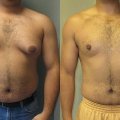 Vyrai vis dažniau ryžtasi krūtų mažinimo operacijai