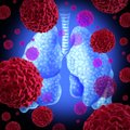 Plaučių vėžio gydymas Lietuvoje: yra dar vienas gydymo būdas, bet progresui yra kliūčių