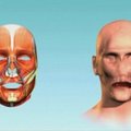 Pacientui JAV pirmą kartą persodintas visas veidas