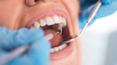 Neskubėkite išmesti iškritusių ar išrautų dantų – jie gali pasitarnauti 