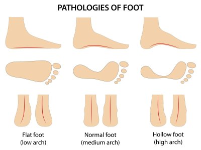 Pėdos skliautų išlinkimo tipai: normalus išlinkimas (normal); aukštas išlinkimas (high) ir plokščiapėdystė (flatfoot)