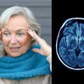 Nauji atradimai žmogaus smegenyse – mokslininkai ištyrė, kas iš tiesų turi įtakos demencijos išsivystymui