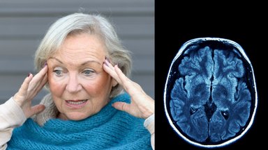 Mokslininkai mano radę būdą, kaip sustabdyti Alzheimerio ligą: skeptikai pažėrė kritikos