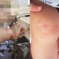 Mama parodė, ką Turkijoje siaučiantis virusas padarė jos vaikui: oda luposi gabalais