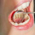 Nesirūpinimas dantenomis gali turėti liūdnų pasekmių – gresia rimtos ligos