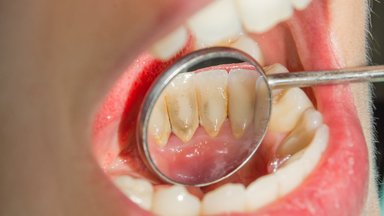 Nesirūpinimas dantenomis gali turėti liūdnų pasekmių – gresia rimtos ligos