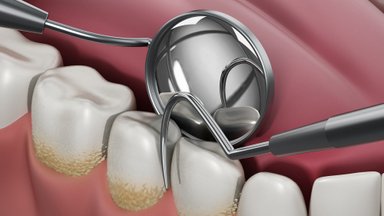 Burnos higienistė išvardijo, kokie simptomai byloja apie beprasidedantį dantenų uždegimą
