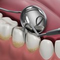 Burnos higienistė išvardijo, kokie simptomai byloja apie beprasidedantį dantenų uždegimą
