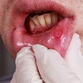 Maža žaizdelė burnoje ir ausies skausmas gali pranešti apie itin pavojingą vėžį