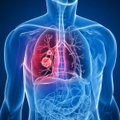 Laiku aptikti plaučių vėžį sudėtinga: siūlo sprendimą, galintį padėti jį nustatyti kuo anksčiau
