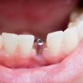 Pažėrė baudų: įmonės trukdė pigiau siūlyti dantų implantavimą