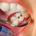 Neskubėkite atverti piniginės: ligonių kasos nurodė, kada už dantų gydymą mokėti nereikia