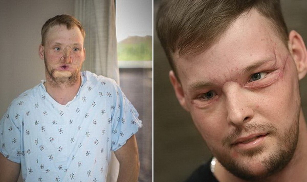 Andy prieš ir po operacijos