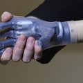 Lietuvis tapo pirmuoju pasaulyje su išskirtine bionine ranka
