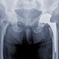 Aktyviausiai ortopedines priemones grąžina panevėžiečiai