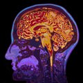 Tyrimai parodė, kokių pakitimų smegenyse atsiranda net po lengvos „Covid-19“ ligos formos