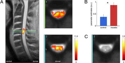 fMRI tyrimas parodė: juntamas skausmas buvo tikras (Hamburgo-Ependorfo universiteto iliustr.)