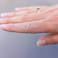 Netinkamai prižiūrint rankų odą gali išsivystyti ir nemalonios ligos: jų galima išvengti