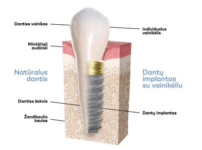 Dantų implantas/ „Nobel Biocare“ nuotr.