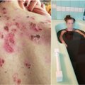Barbora vienintelė Lietuvoje serga tokia nepagydoma liga: žaizdos atsiranda nuo prisilietimo