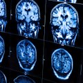 Alzhaimerio ir kitų neurodegeneracinių ligų gydymo fronte – vilties spindulėlis