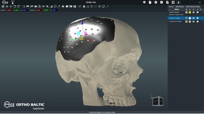 Individualus kranialinis implantas buvo pagamintas 3D spausdintuvu