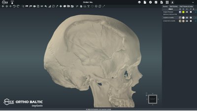 Individualus kranialinis implantas buvo pagamintas 3D spausdintuvu