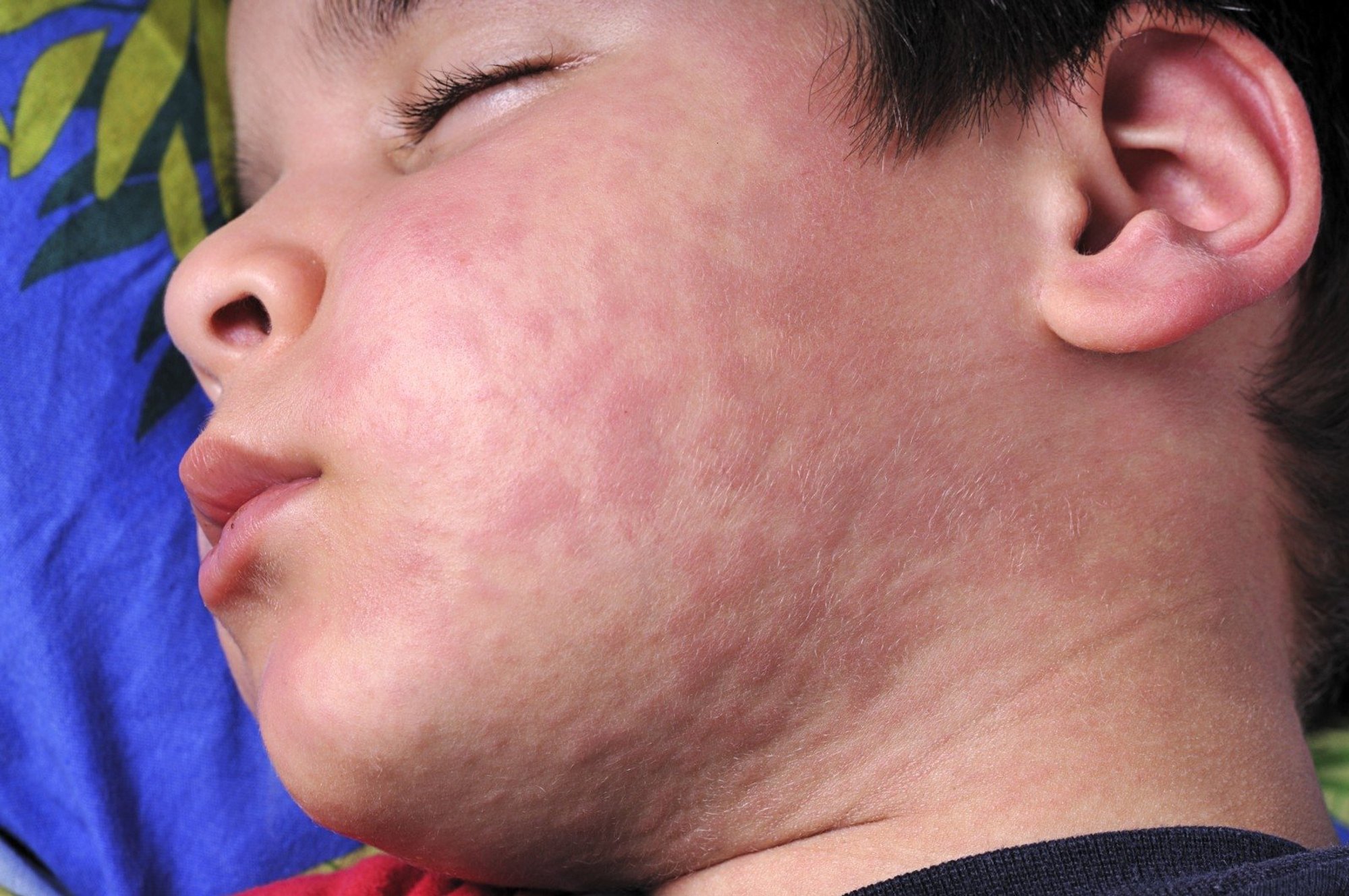 PSO Lietuva jau panaikino tymus ir raudonukę Delfi sveikata