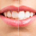 Dantų balinimas namuose: šypsena akinančiai spindės lyg ką tik išėjus iš stomatologo