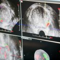 Mirtingumas nuo prostatos vėžio Lietuvoje vienas didžiausių – ką vyrams reikia žinoti apie šią ligą