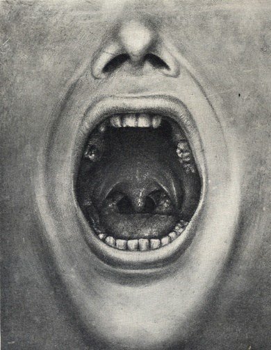 H. Cottono pacientas ištrauktais dantimis