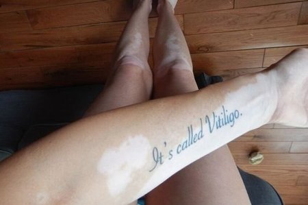 Vitiligo tatuiruotė