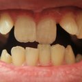 Dantų priežiūra: kramtomoji guma – padeda ar kenkia?