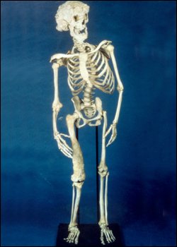 Josepho Merricko skeletas