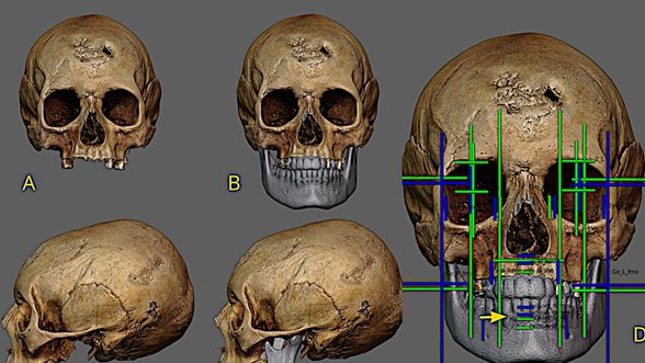 Prieš 500 metų gyvenusios moters veidą sudarkė šiurpi infekcija: kaukolę rekonstravę mokslininkai atkūrė, kaip ji atrodė