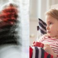 Tuberkuliozė neaplenkia ir Lietuvos vaikų: šeimos gydytojai besiruošiantiems į mokyklą atlieka testą