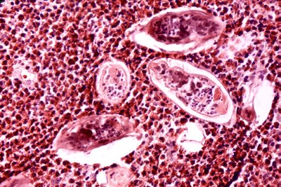 Šistosomatozė, lėtinė parazitinė liga, sukelianti stiprų karščiavimą ir galinti būti mirtina.
