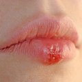 Lūpų pūslelinę padės įveikti paprasti produktai