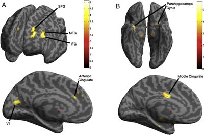 Vienkalbių ir dvikalbių žmonių smegenų sričių aktyvumo skirtumų žemėlapis. (Tyrimo autorių nuotr.)