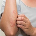 Dėl alergijos tenka keisti darbą: gydytoja papasakojo, kokių profesijų specialistai kenčia labiausiai
