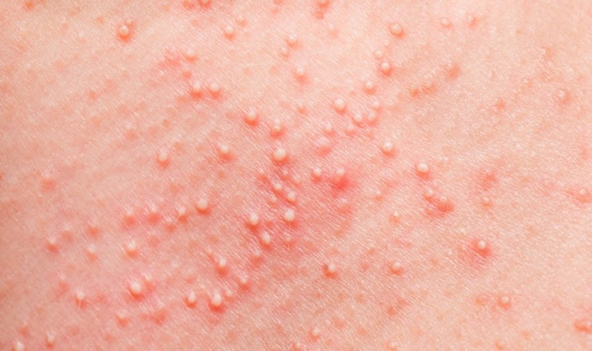 alergija, bėrimas, oda, egzema,liga, dermatitas