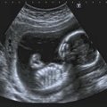 Skandalas Britanijoje: abortai daryti dėl kūdikio lyties